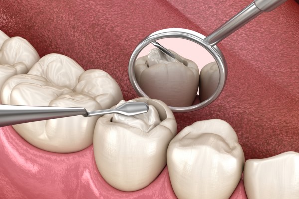 Signs You Should Have Your Silver Fillings Replaced