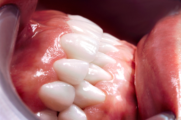 What Is Gum Grafting?